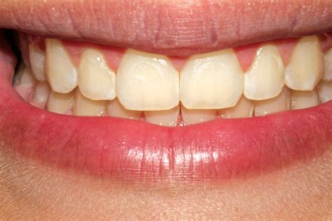 Icon Treatment Of Post Orthodontic White Spot Lesions Oral Health Group