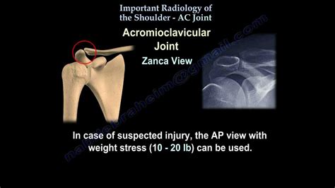 The Shoulder Ac Joint Radiology Everything You Need To Know Dr