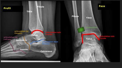 Imagerie Des Entorses De Cheville Imagerie De L Appareil Locomoteur