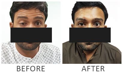 Eye Ptosis Surgery in Karachi - Reclaim Your Bright, Open Gaze