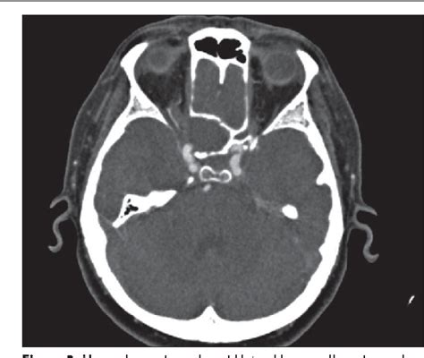 Table 1 From Isolated Sphenoid Sinus Pathologies The Problem Of Delayed Diagnosis Semantic