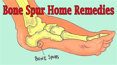 Effective Home Remedies To Get Rid Of Bone Spur Bone Spur Treatment Youtube