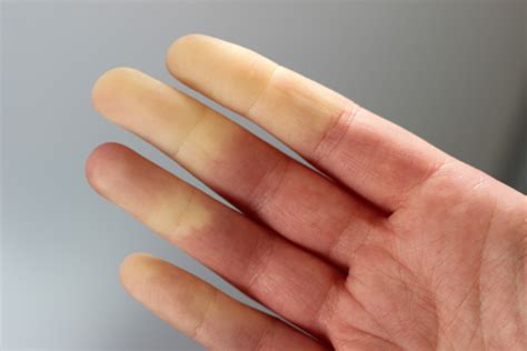 Is Raynauds Disease The Cause Of Cold Throbbing Fingers Richard