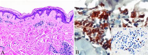 A Representative Photomicrograph Of A Skin Biopsy Specimen Displaying