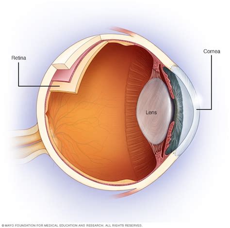 Astigmatism - Symptoms and causes - Mayo Clinic