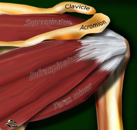 The Radiology Assistant Shoulder Rotator Cuff Injury