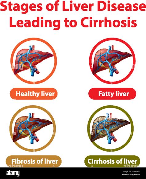 Estadios De La Enfermedad Hep Tica Que Conducen A La Cirrosis Imagen