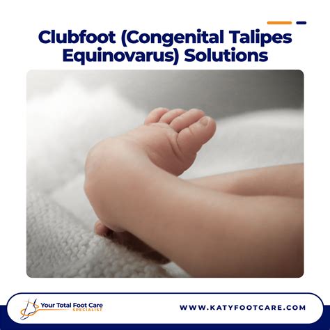 Clubfoot Congenital Talipes Equinovarus Solutions Katy Fx