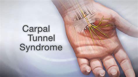 Carpal Tunnel Syndrome Typing All Day On A Computer Keyboard Can Be