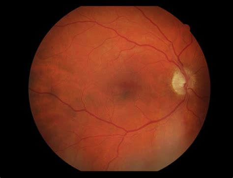 Elschnig Spots Hypertensive Choroidopathy