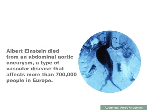 Abdominal Aortic Aneurysm Ppt