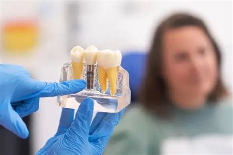 Cu Les Son Las Ofertas De Implantes Dentales En Madrid