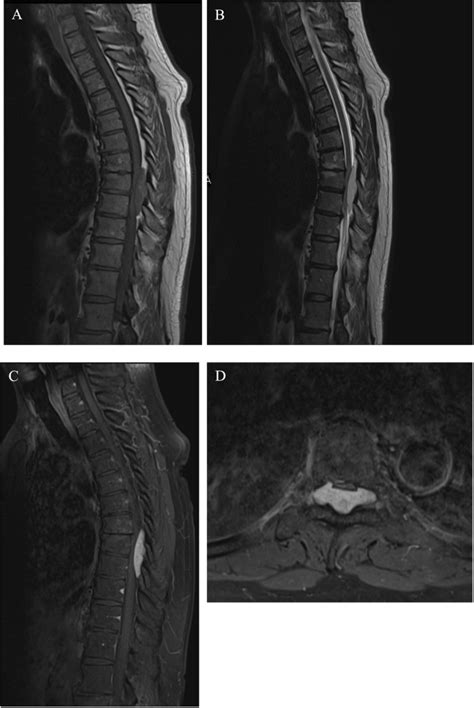 Pure Epidural Extraosseous Cavernous Hemangioma With Thoracic