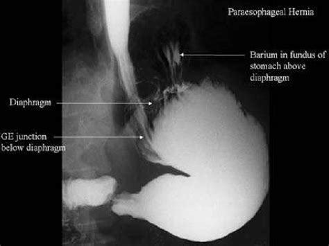 Hernia De Hiato