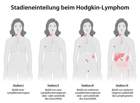 Hodgkin Lymphom Morbus Hodgkin Symptome Behandlung