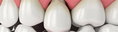 Exposed Tooth Root: Causes and Symptoms - Great Hill Dental Boston