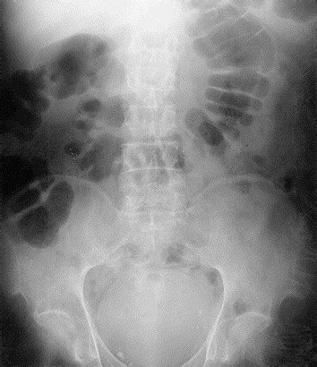 Fecal impaction: a cause of isolated small bowel dilatation on abdominal radiographs - European ...