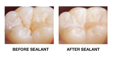 Sealants | Christine Theroux DDS Parker Dentist