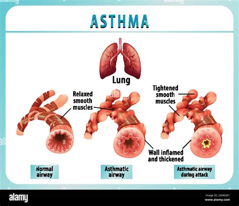 Bronchial Asthma Diagram With Normal Airway And Asthmatic Airway Illustration Stock Vector Image