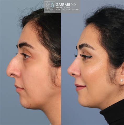 Ultrasonic Piezo Rhinoplasty Dr Shahrouz Zarrabi Md