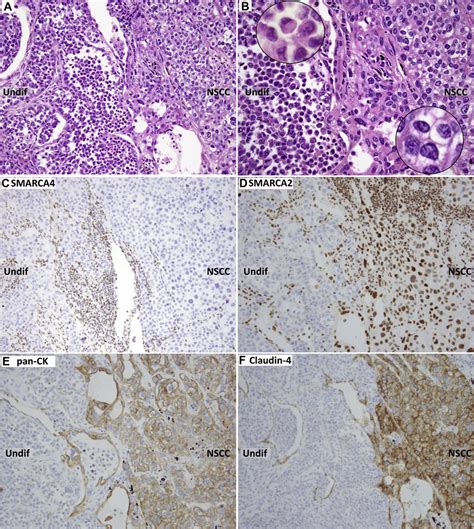 Histopathologic Features Of SMARCA4 Deficient Composite Tumors Case