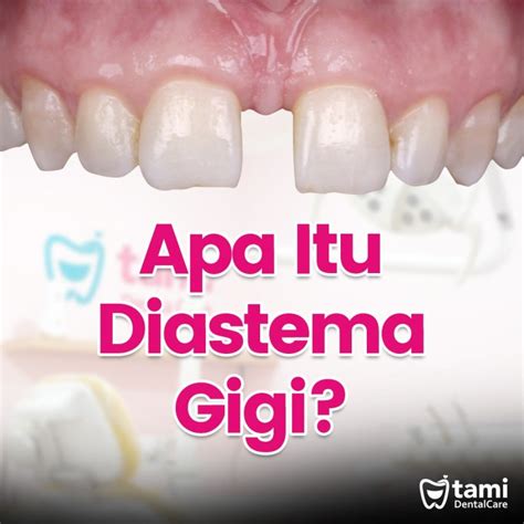 Apa Itu Diastema Tami Dental Care Klinik Dokter Gigi Bandung Bojongsoang Cimahi Antapani