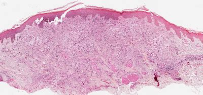 Differential Diagnosis In Dermatopathology Clear Cells