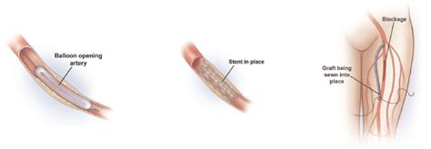 Figure Types Of Revascularization Variation In The Care Of