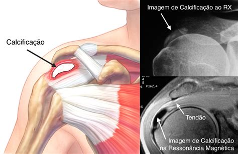 Ortopedista Curitiba Tendinite Calcaria No Ombro 14 Dr Carlos