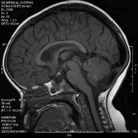 A Sagittal T1w Mri Scan Demonstrating The Hyperintense Posterior