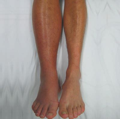 blood clot in leg swelling - Food and Nutrition Website