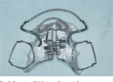 Figure 9 From The Modified Twin Block Appliance In The Treatment Of Class Ii Division 2