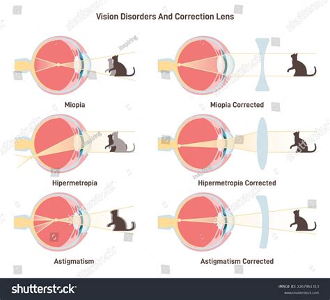 Myopia Hyperopia Astigmatism Common Vision Disorders Stock Vector ...