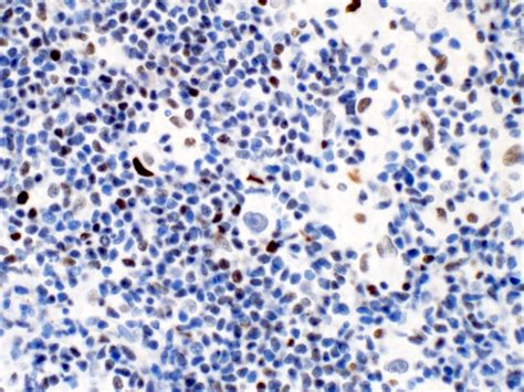 Pathology Outlines Bcl