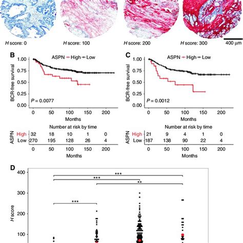 Correlation Of Aspn Protein Expression With Bcr Using Ihc Staining Of A