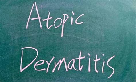 Lebrikizumab Demonstrates Efficacy In Atopic Dermatitis And Skin Of