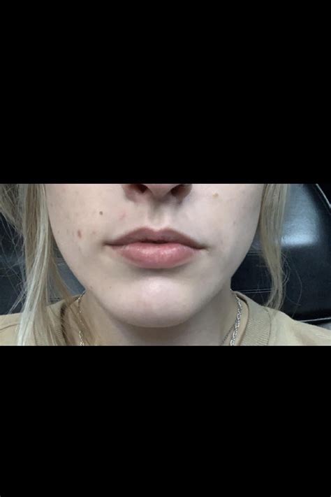 My Lip Filler Journey Rplasticsurgery