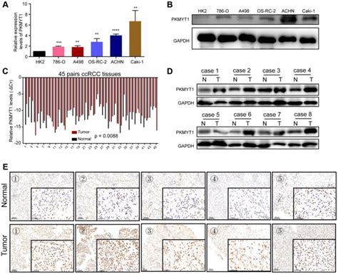 Overexpression Of Pkmyt In Renal Cancer Cells And Tissues The