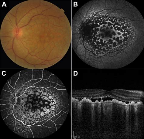 Giraffe Pattern Of Bilateral Diffuse Uveal Melanocytic Proliferation