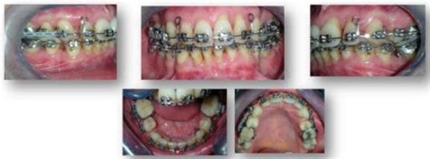 Intraoral Views During Orthodontic Treatment Download Scientific Diagram