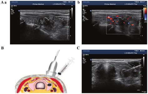 Thyroid Nodules Biopsy