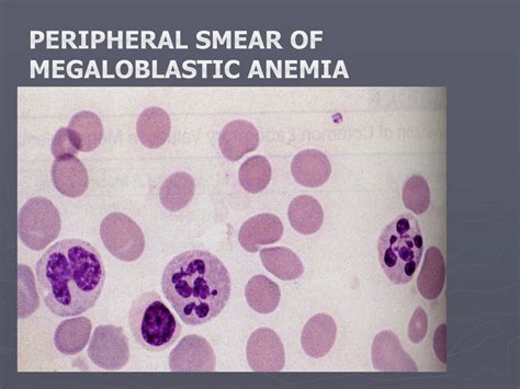 Ppt Macrocytic Anemias Powerpoint Presentation Free Download Id 9145377