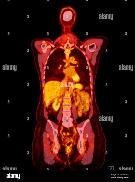 A Pet Ct Scan Image Is A Diagnostic Visualization Combining Positron