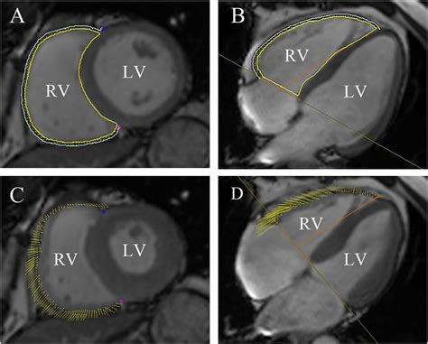 Cmr Feature Tracking Using Cmr42 Circle Cardiovascular Imaging Inc Download Scientific