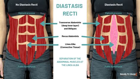 Diastasis Recti What It Is How To Fix It NBKomputer