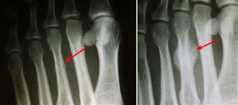 Toe And Forefoot Fractures Orthoinfo Aaos