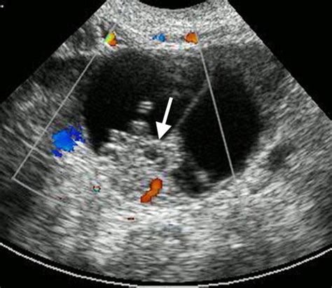 Adnexal Masses US Characterization And Reporting Radiology