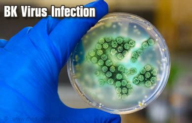 BK Virus Infection - Risk Factors, Symptoms, Signs, Diagnosis ...