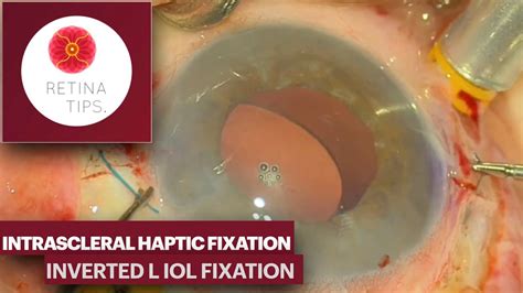 IOL Scleral Fixation Techniques Inverted L IOL Fixation YouTube