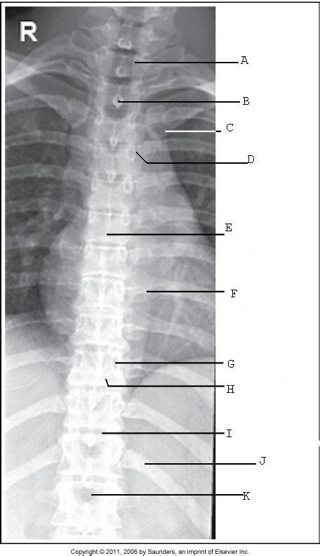 Ap T Spine Anatomy Radiograph Diagram Quizlet